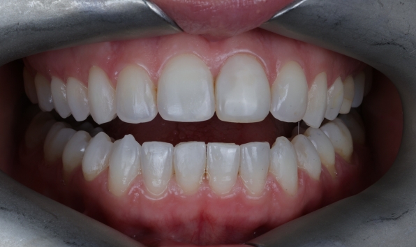 Aligners - Case 1 after