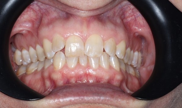 Aligners - Case 2 before