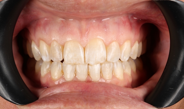 Aligners - Case 2 after