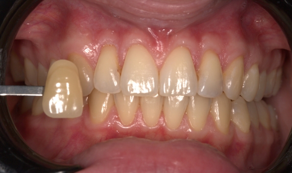Teeth whitening case 1 before
