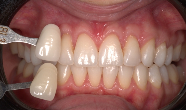 Teeth whitening case 1 after