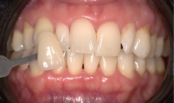 Teeth whitening - case 2 after