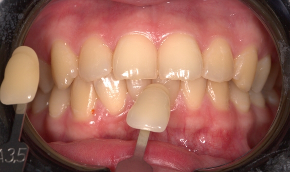 Teeth whitening - case 3 before