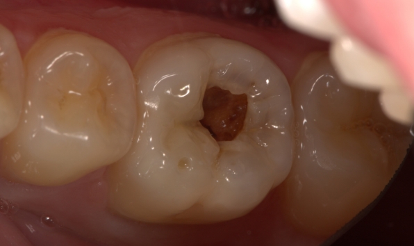 Composite bonding - case 1 before