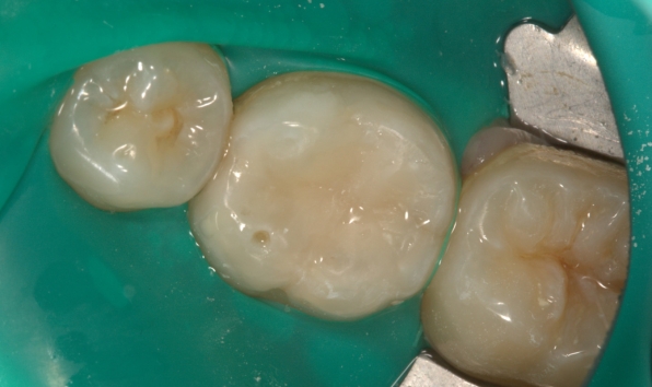 Composite bonding - case 1 after