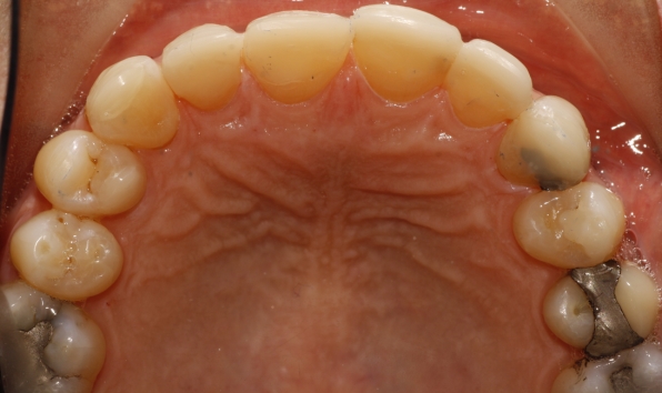 Composite bonding - case 2 after