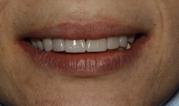 Smile makeover with crowns - case 2 after