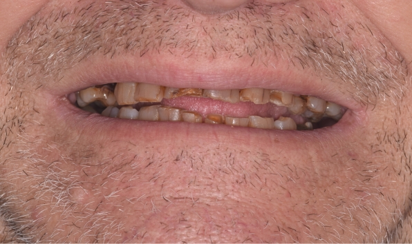 Oral rehabilitation - case 1 before