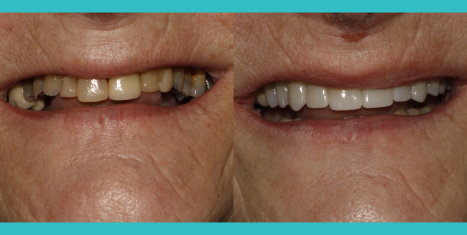 Oral rehabilitation