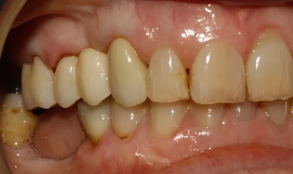 Bridges - Case 2 after