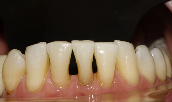 Composite bonding - case 3 - lower teeth before