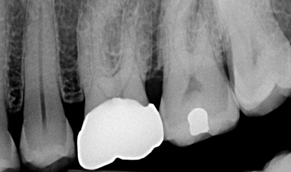 Root canal treatment - Case 1 before