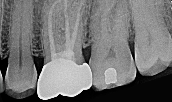 Root canal treatment - Case 1 after