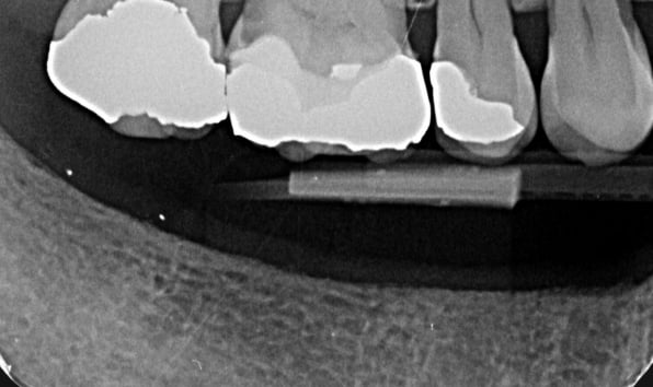 Dental implants - Case 1 before