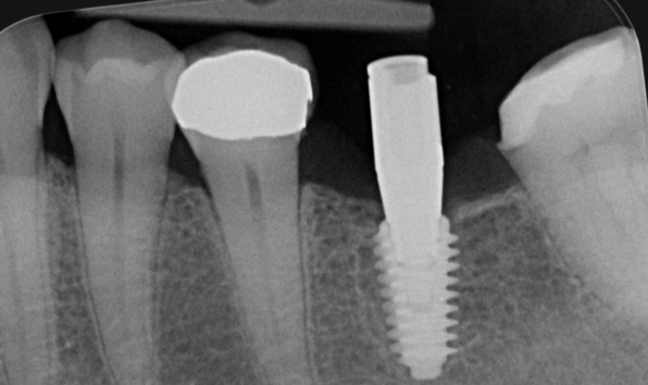 Dental implants - Case 2 before