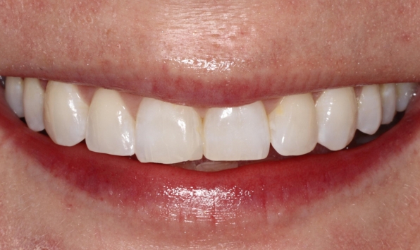 Composite bonding - case 1 before